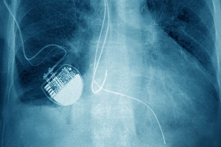 Technoloty News :  Medical device maker Medtronic finally fixes its hackable pacemaker .
